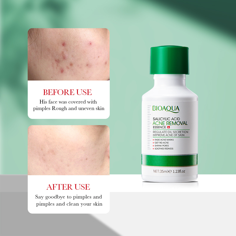 35ml BIOAOUA Salicylic Acid An - Tranexamic Acid Serum recensione e prezzo